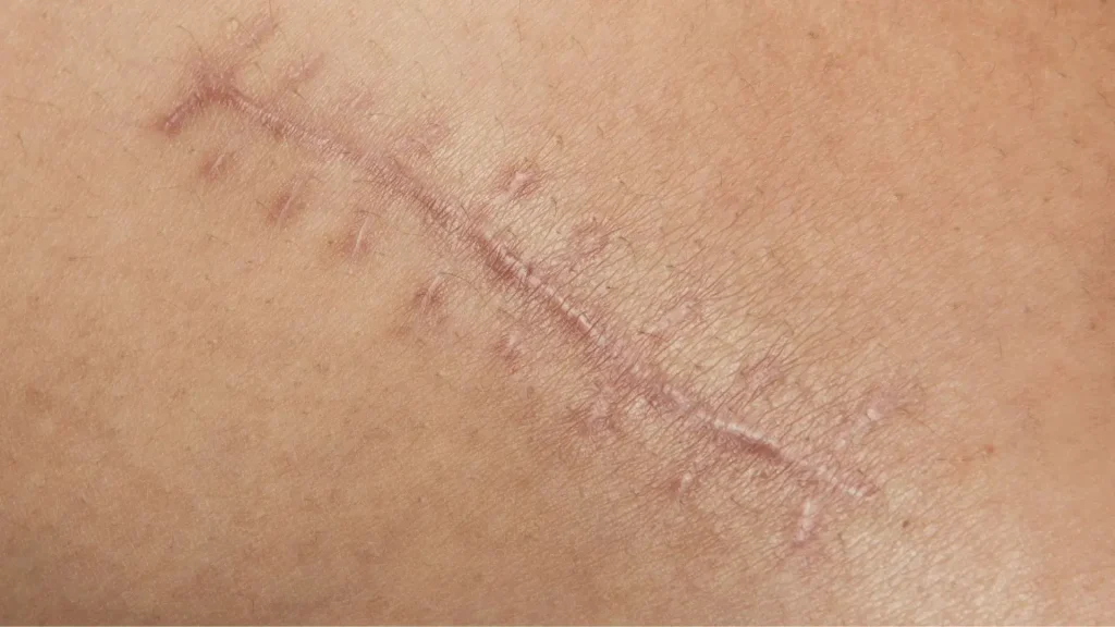 cicatriz sin micropigmentacion de cicatrices
